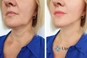 Double chin before and after Hi-Fu treatment 4 Book your double chin treatment Watford today! We are here to help!