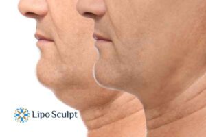 Double chin before and after Hi-Fu treatment 2 Double chin treatment Watford from Lipo Sculpt - feel more confident today!