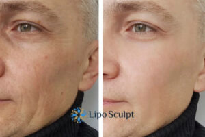 How to Fight Aging Symptoms 3 Fight Aging Symptoms Watford With HIFU and Morpheus8 Today!