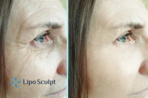 How to Fight Aging Symptoms 2 Do you want to Fight Aging Symptoms Watford? Contact Lipo Sculpt today!