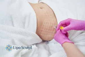 Are The Results From Aqualyx Permanent? 1 Do you want to know how long Aqualyx Watford results last?