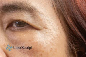 Cryopen: The Revolutionary Treatment for Age Spots Unveiled 2 Are age spots Watford giving you low self esteem? Contact us today!