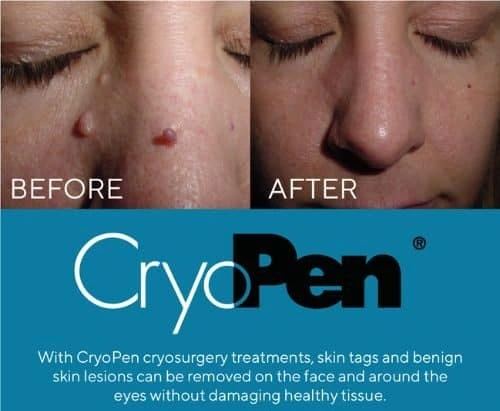 image of angiofibroma removal Watford using Lipo Sculpt cryopen!